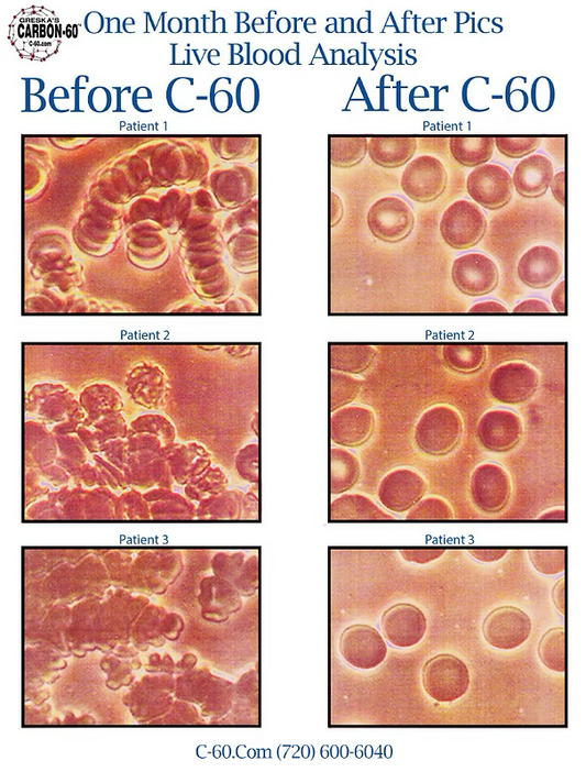 Carbon C60: Live Blood Analysis Revealed: Customer Blood Tests Before and After Pictures as Their  Evidence of Greska's C60